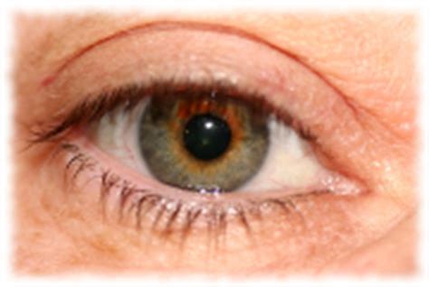 Inflamatii oculare in diabet